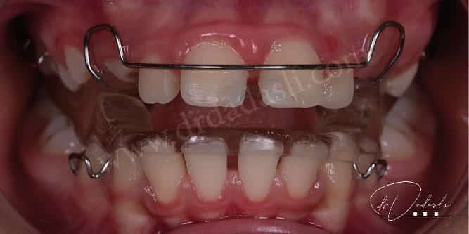 Hareketli fonksiyonel ortodontik tedavi için kullanılan Twin Block apareyi.
