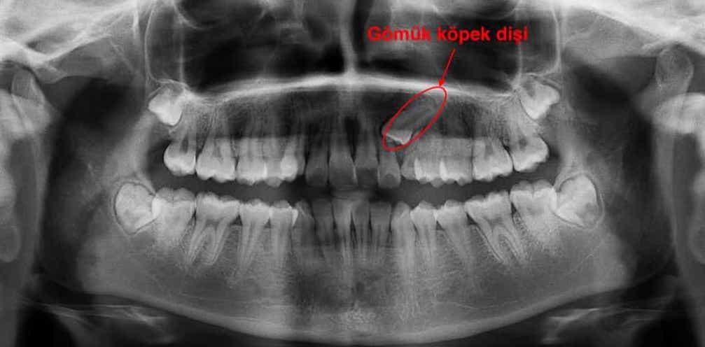 gömülü diş